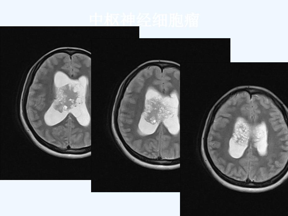 医影在线cns疾病影像图库(医学)_第4页