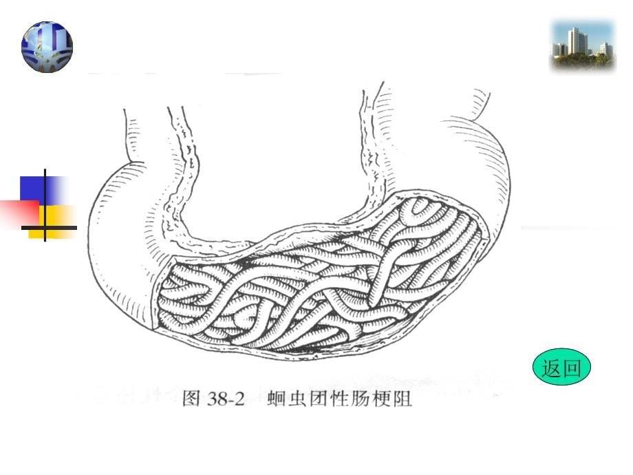 肠梗阻ppt教材_第5页