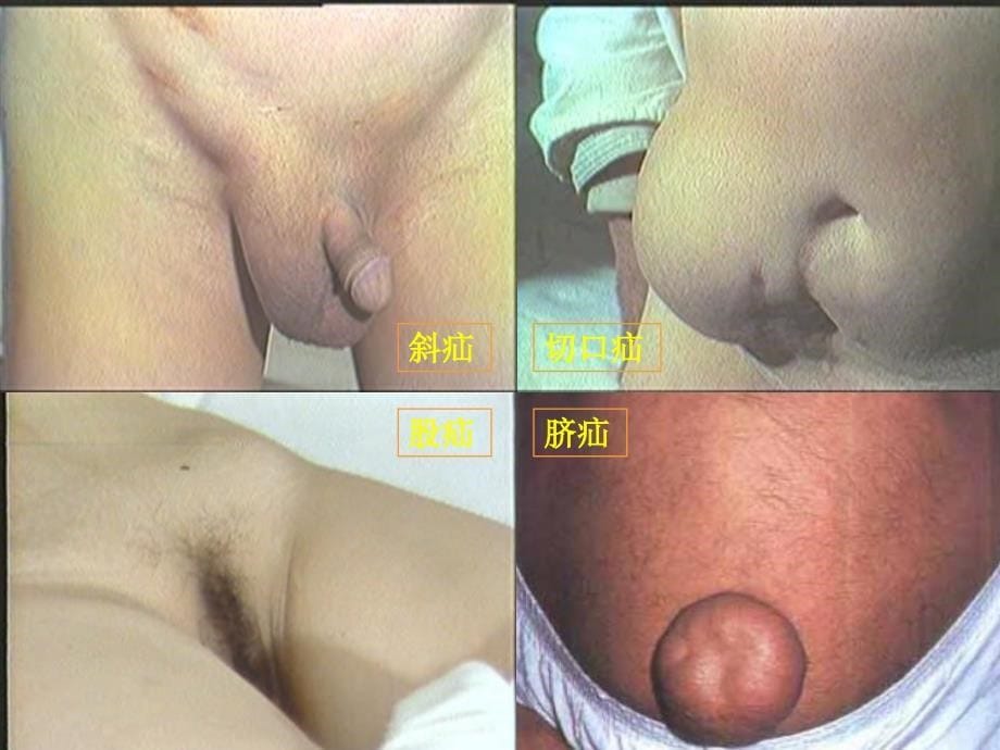 微软用户-腹外疝Abdominal External Hernia_第5页