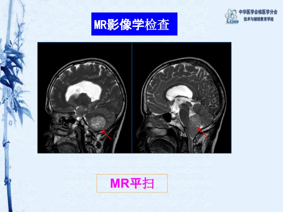 小脑发育不良性节细胞瘤 PET CT显像一例_第4页