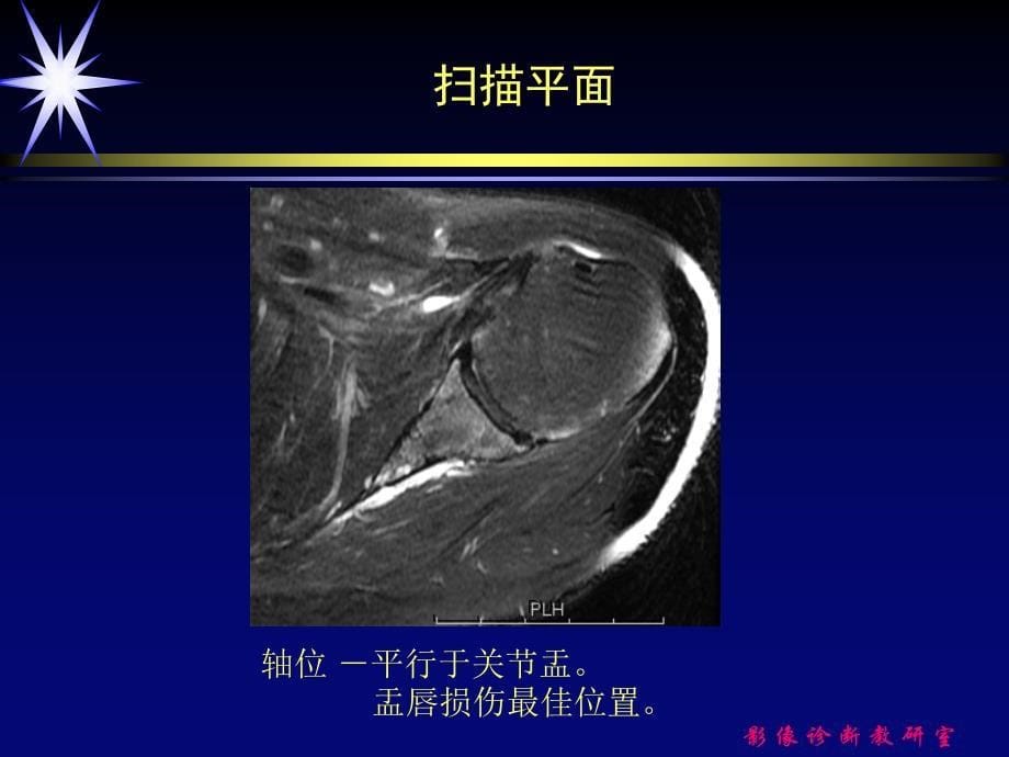 肩关节损伤的mri诊断_第5页