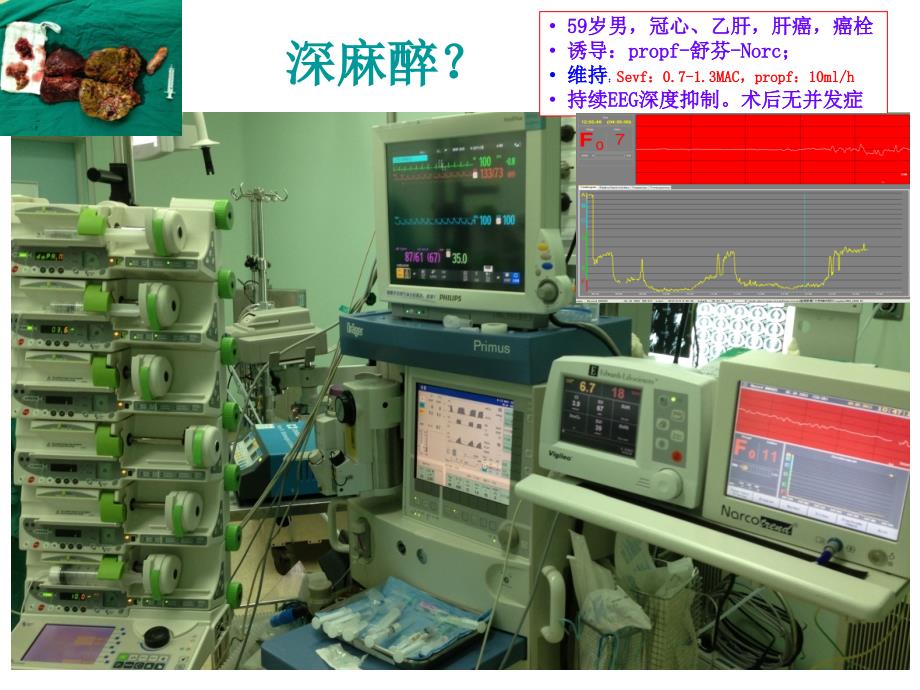 最新 精确麻醉与脑电监测_第4页