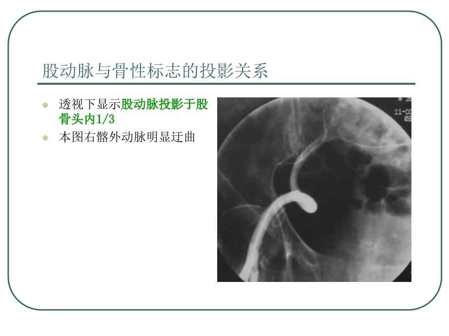 最新 股动、静脉穿刺术_第5页