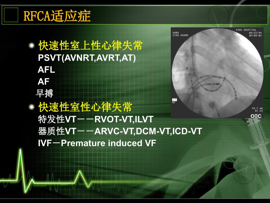 最新 心内电生理检查和导管射频消融基本知识_第3页