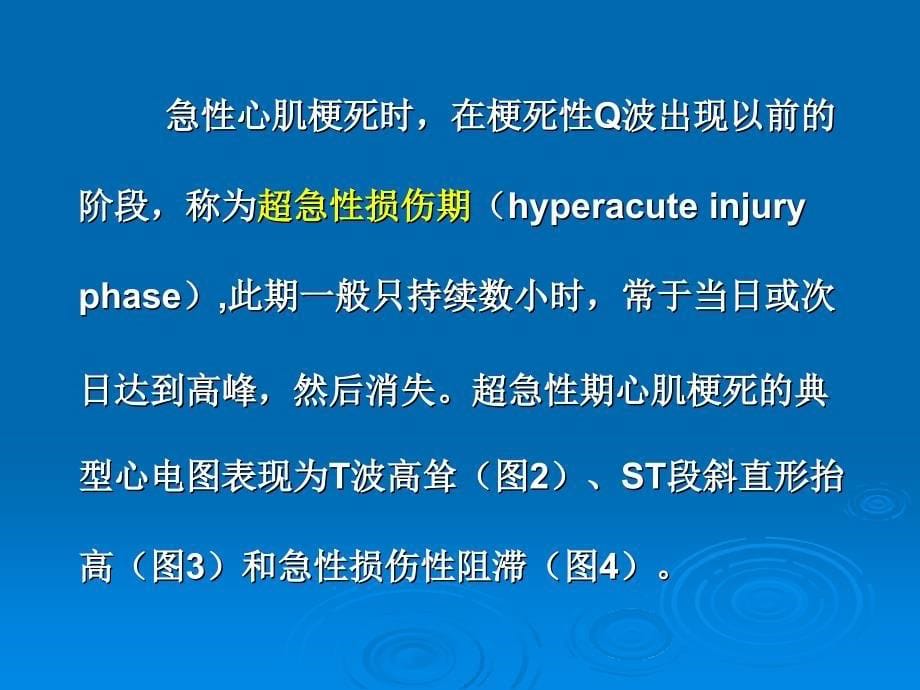 最新 巨R波形ST段抬高的特性及其临床意义_第5页