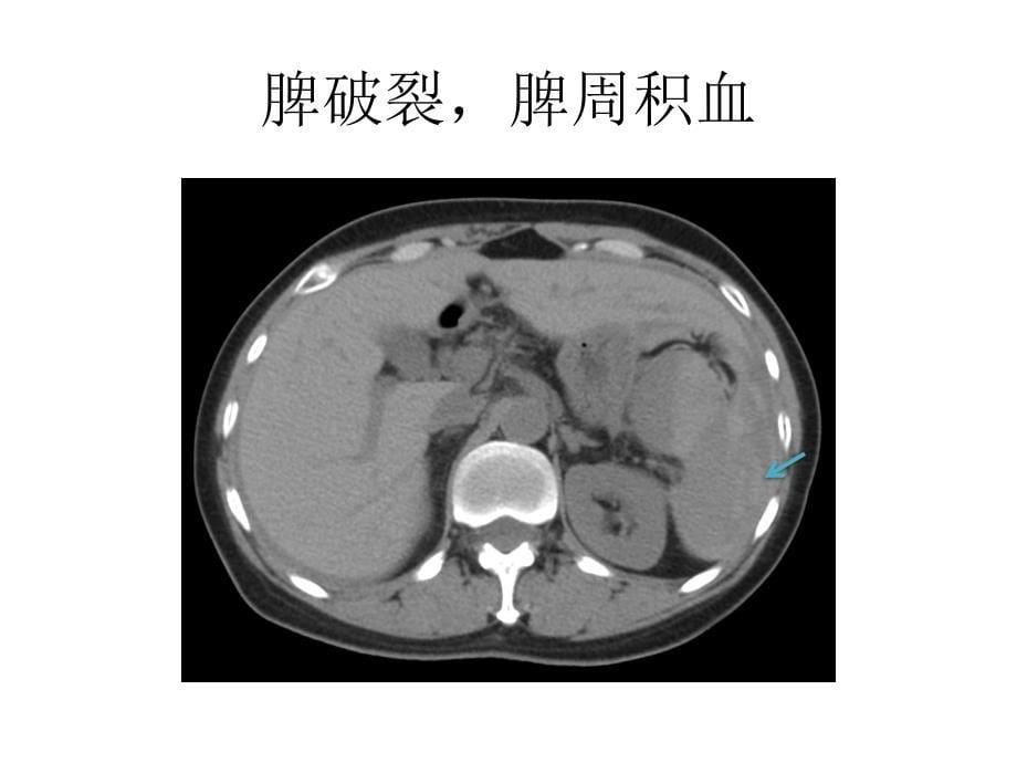 腹部实质性脏器外伤的ct表现_第5页