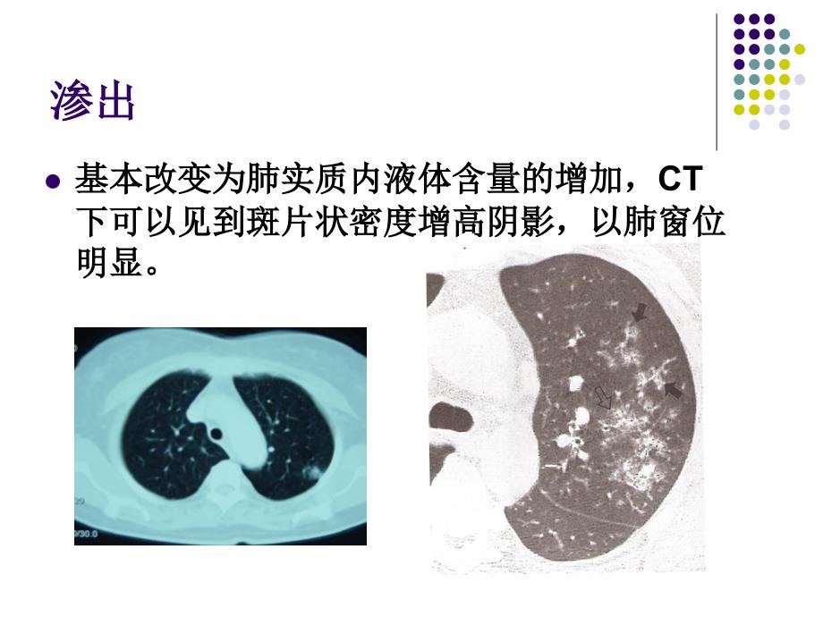 肺部常见病变的ct表现_第4页