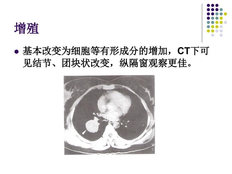 肺部常见病变的ct表现_第5页