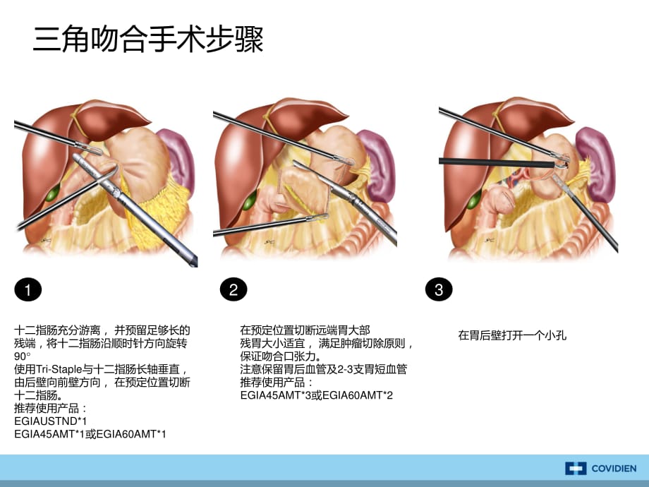 三角吻合术式介绍资料_第4页