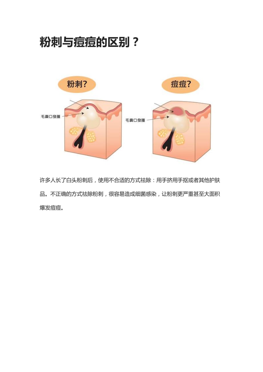 粉刺与痘痘的区别？_第1页