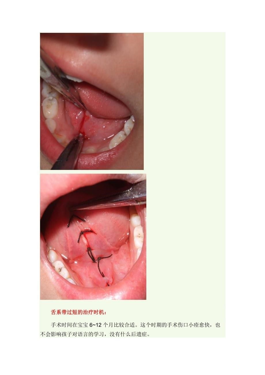 舌系带过短_第5页