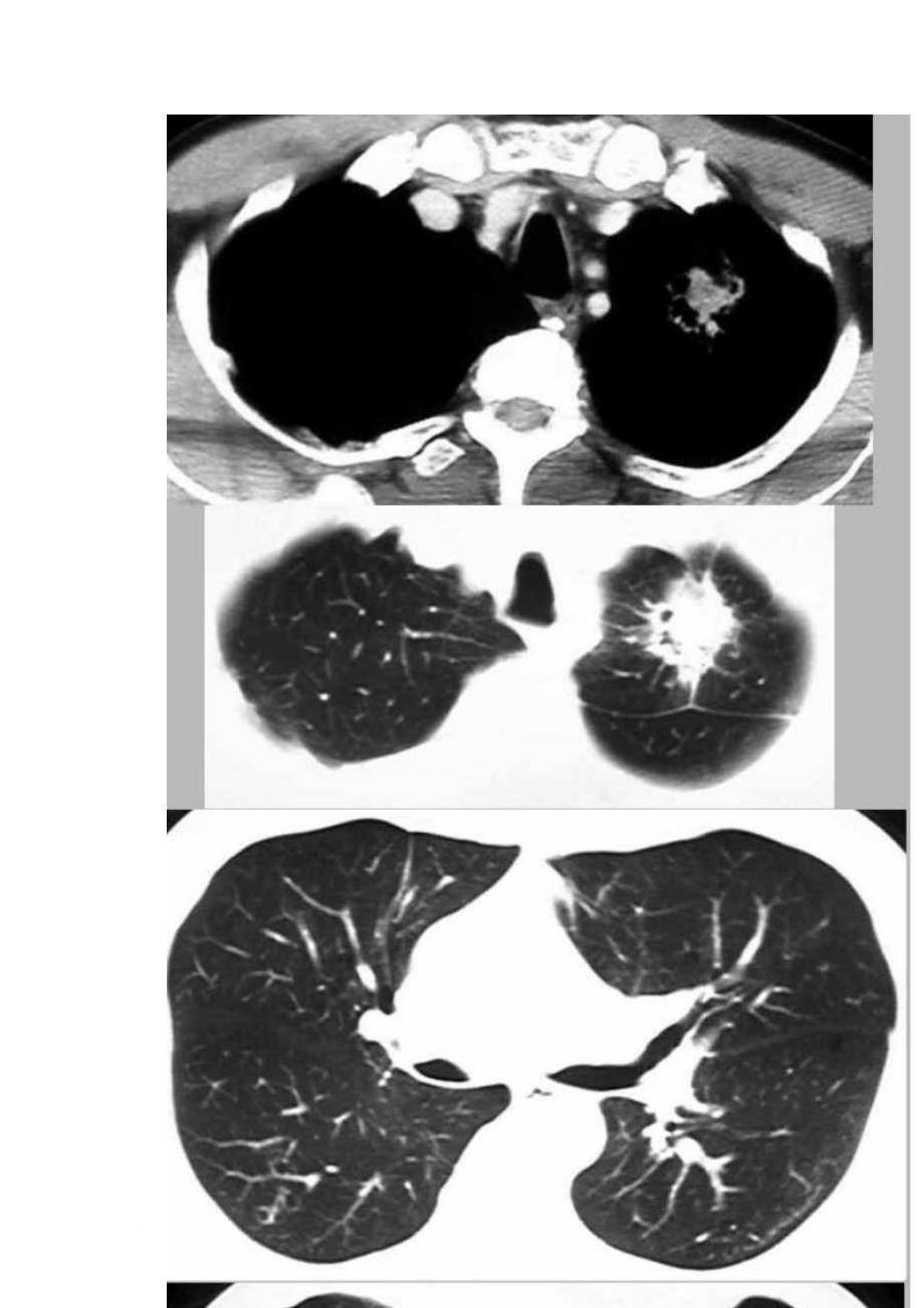 肺部转移瘤的影像诊断_第4页