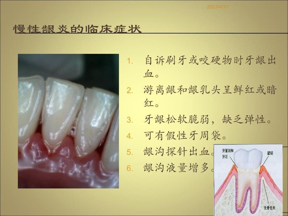 常见牙周疾病资料_第5页