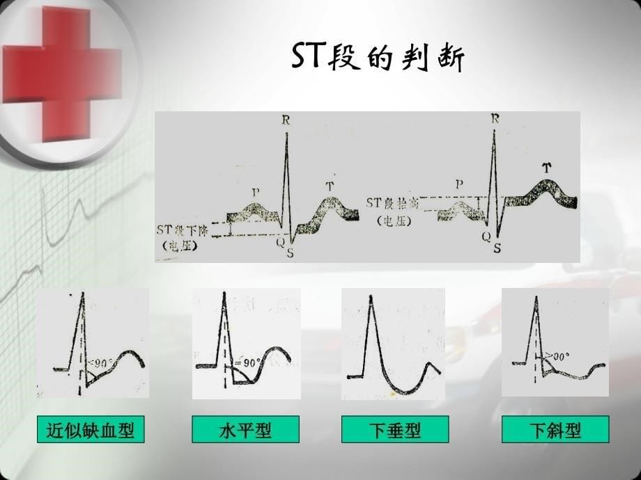 常见心电图的识别资料_第5页