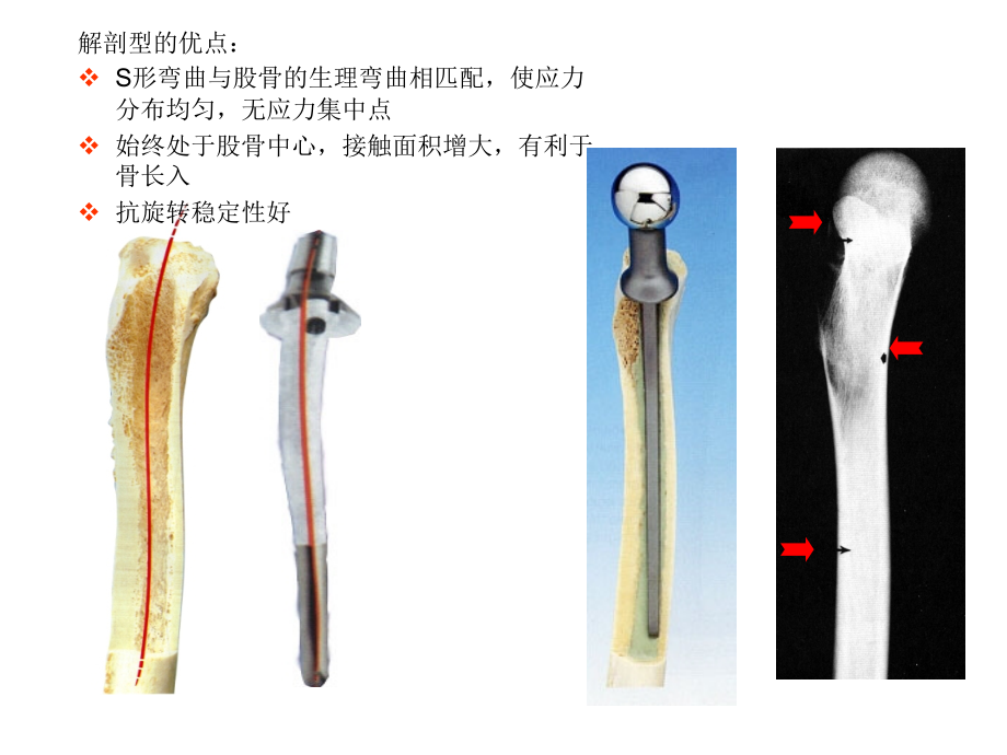 常用髋关节假体资料_第3页