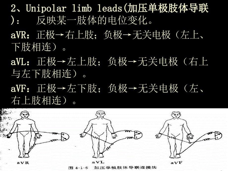 常见典型心电图诊断资料_第5页