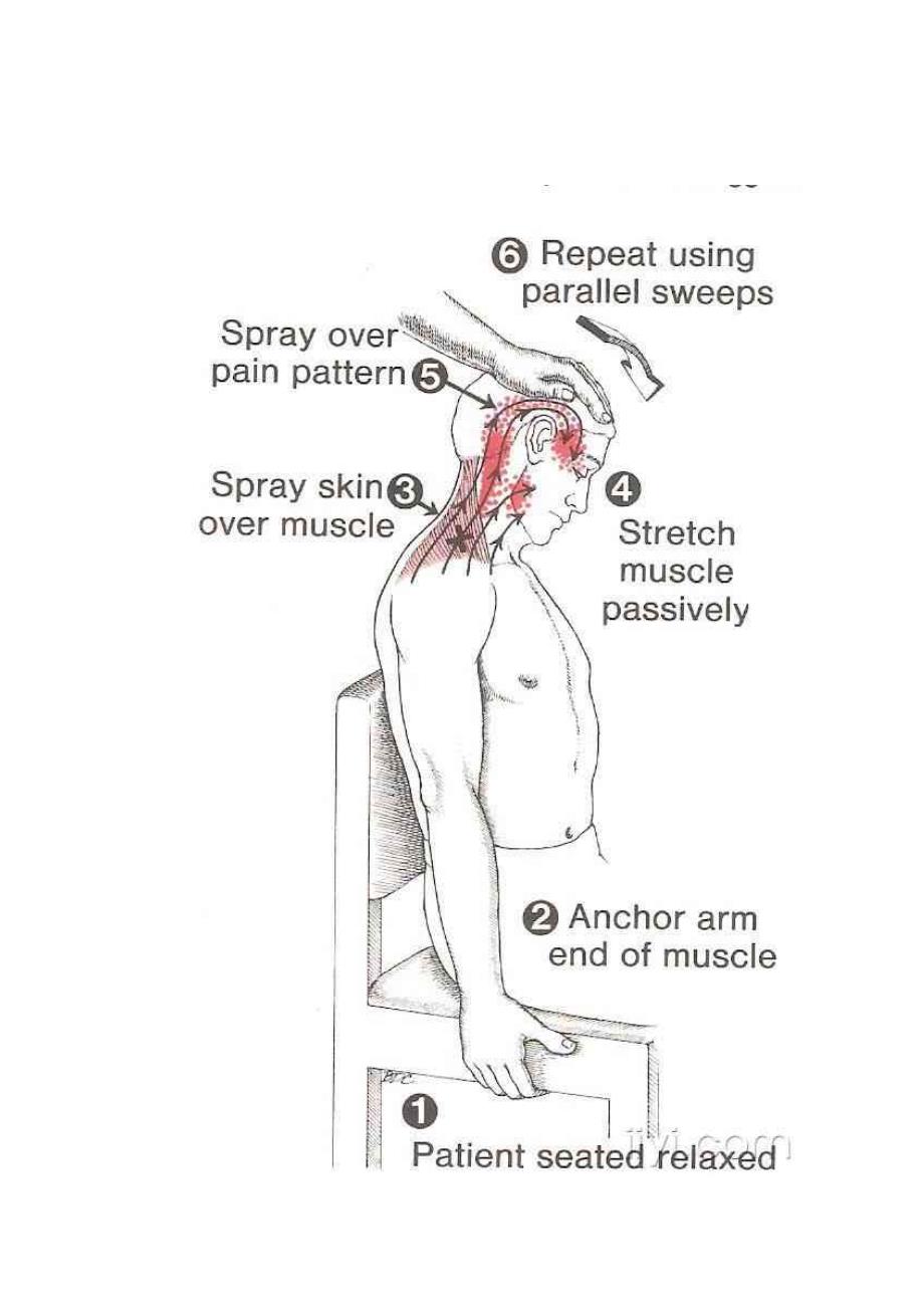 肌筋膜触发点的图解资料_第4页