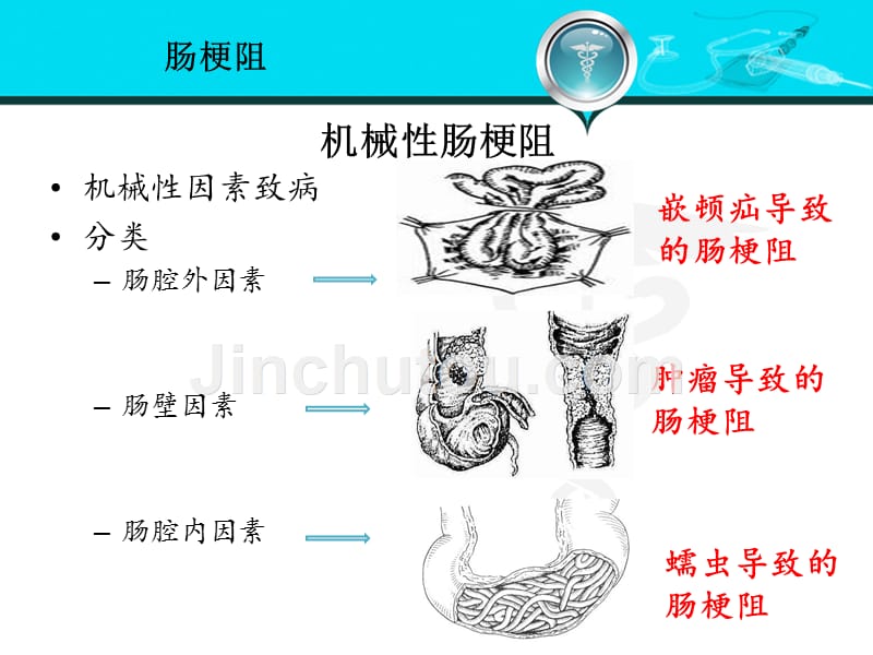 肠梗阻的诊断思维资料_第4页