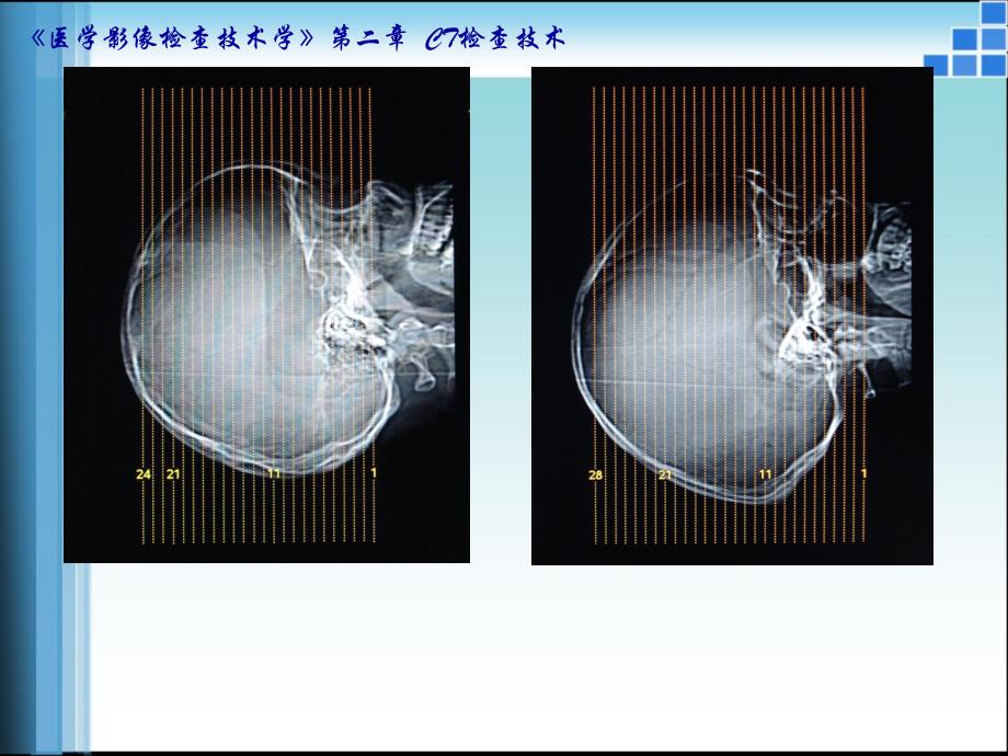 医学影像检查技术学第2版).多媒体课件第06节_第4页