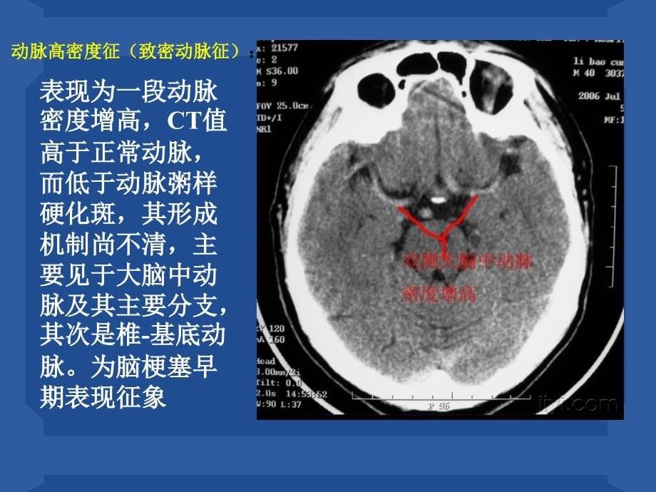 CT特殊影像_第5页