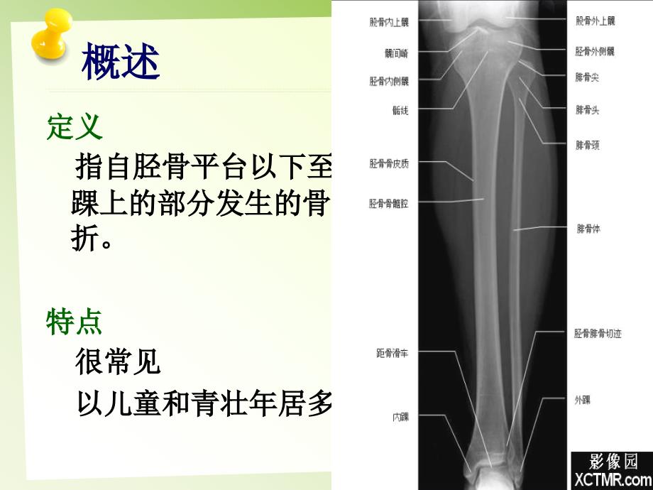 胫腓骨骨折的护理-课件（PPT演示）_第4页