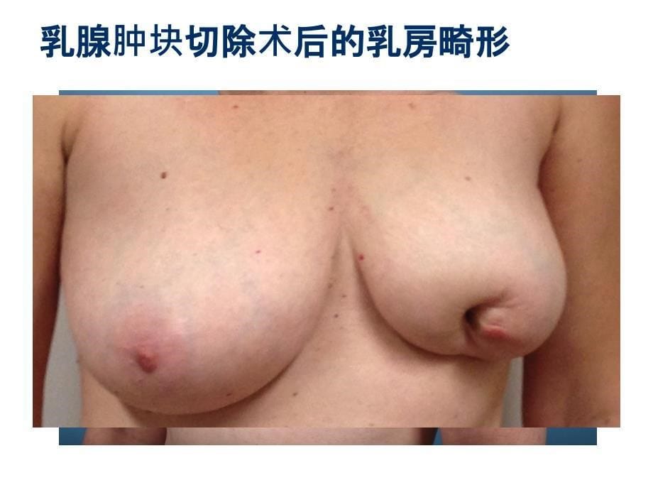 整形保乳术_第5页