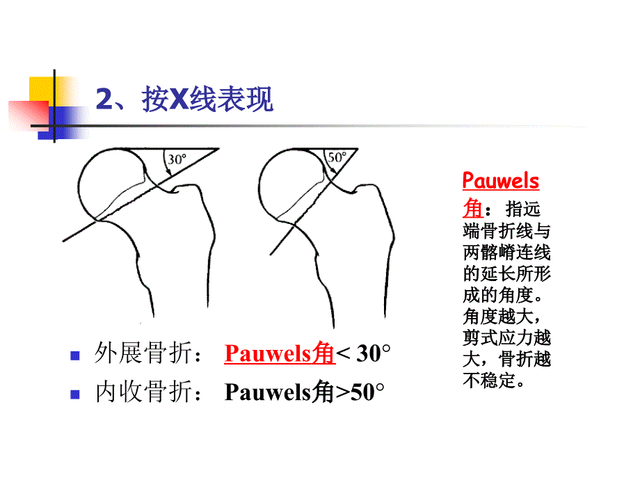 股骨颈骨折的护理资料_第4页