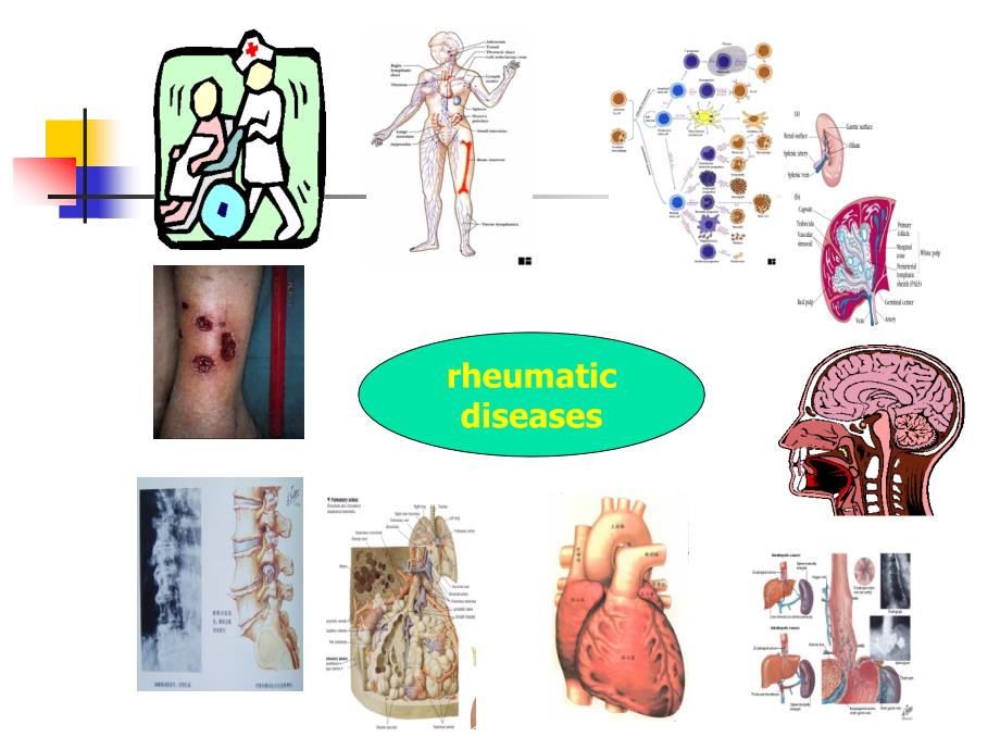 风湿性疾病概论 (2)_第3页