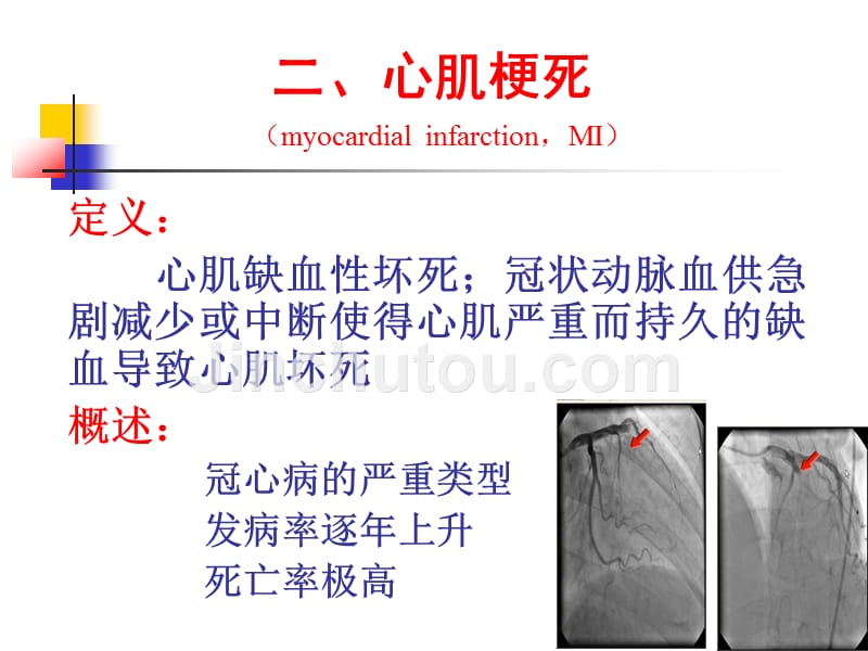 心肌梗死课件精_第2页