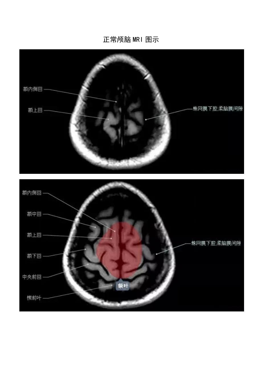 正常颅脑磁共振图示资料_第1页