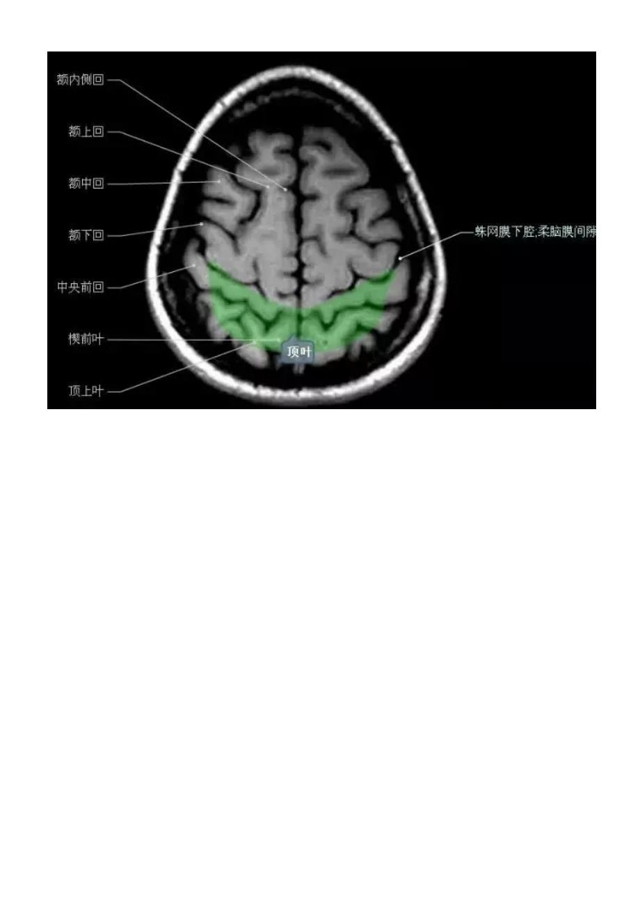 正常颅脑磁共振图示资料_第2页