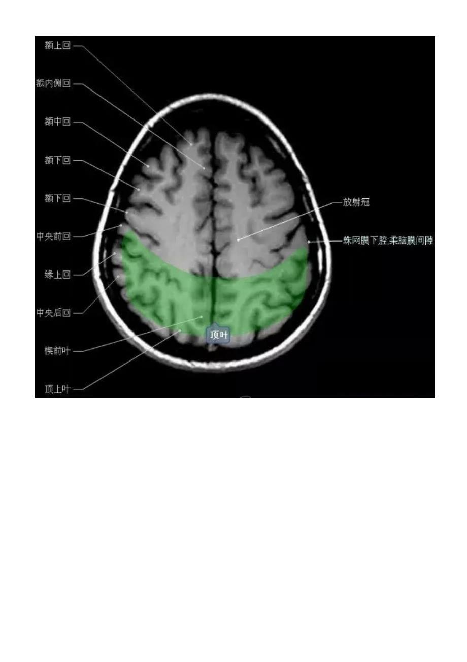 正常颅脑磁共振图示资料_第4页