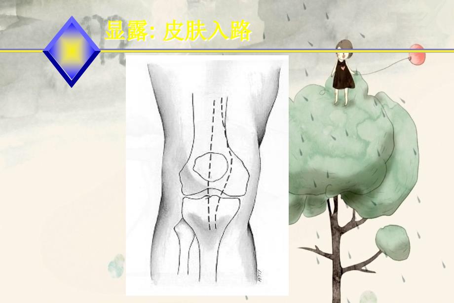 人工全膝置换术韧带平衡中文_第4页