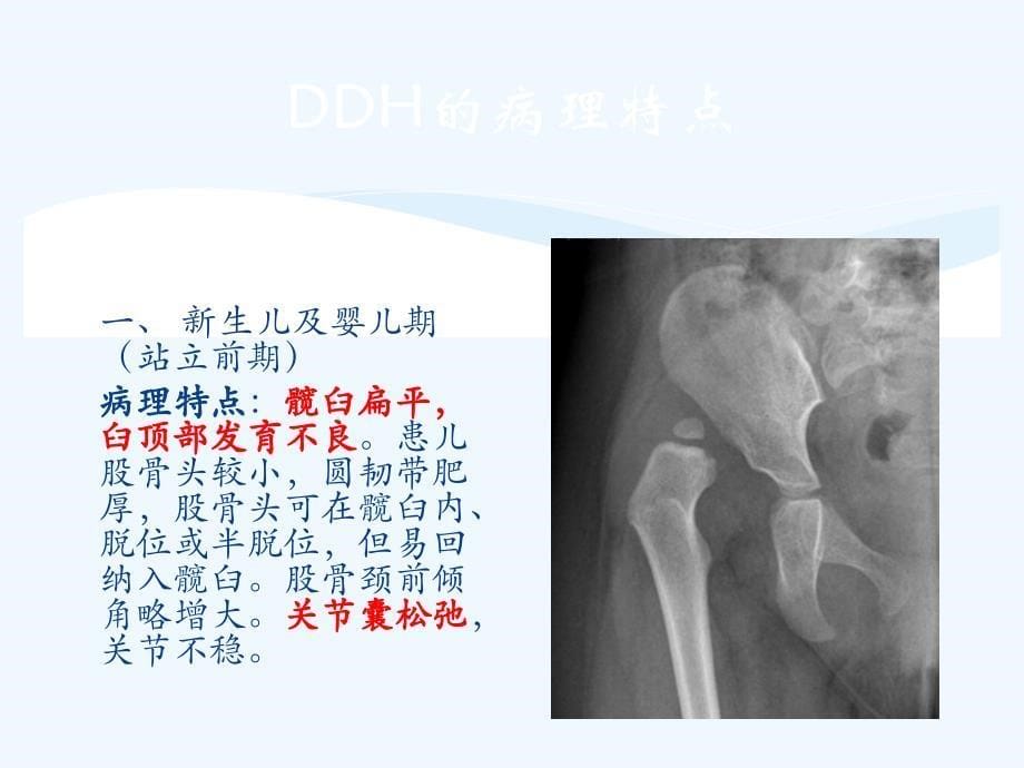 DDH的病程发展及治疗总结_第5页