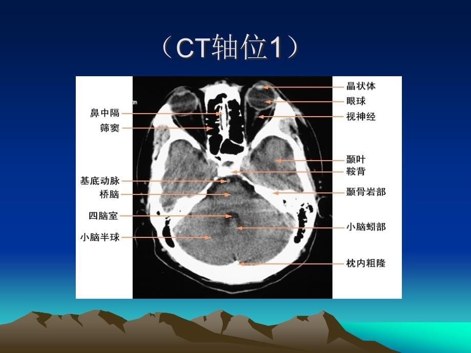 颅脑解剖及颅脑外伤性疾病CT诊断_第5页