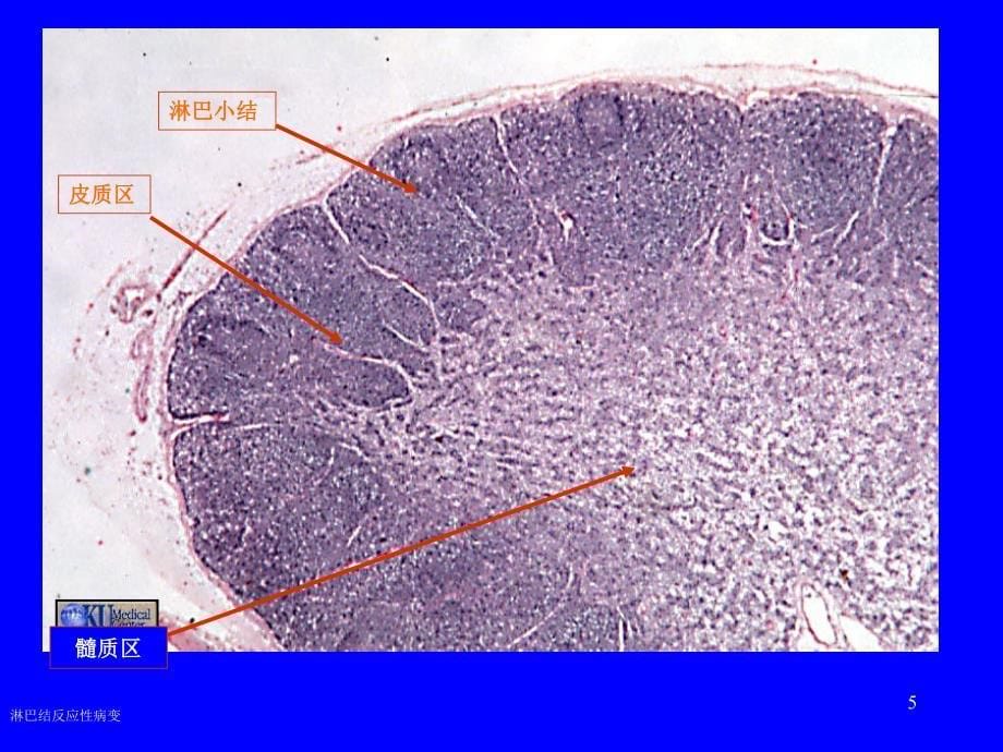 病理学第16章淋巴造血PPT_第5页