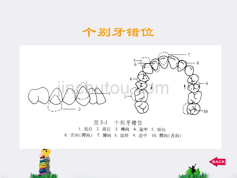 错颌畸形临床表现与分类_第3页