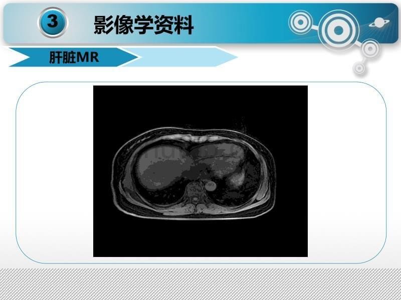 肝脏神经内分泌肿瘤_第5页