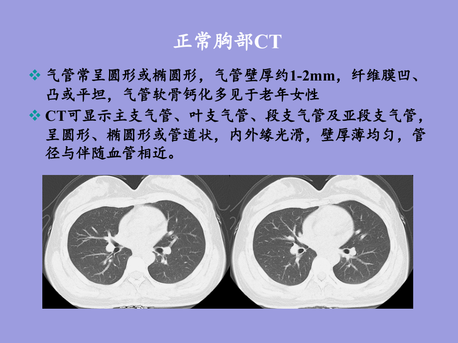 胸部CT下基本解剖与胸部一般病变_第3页
