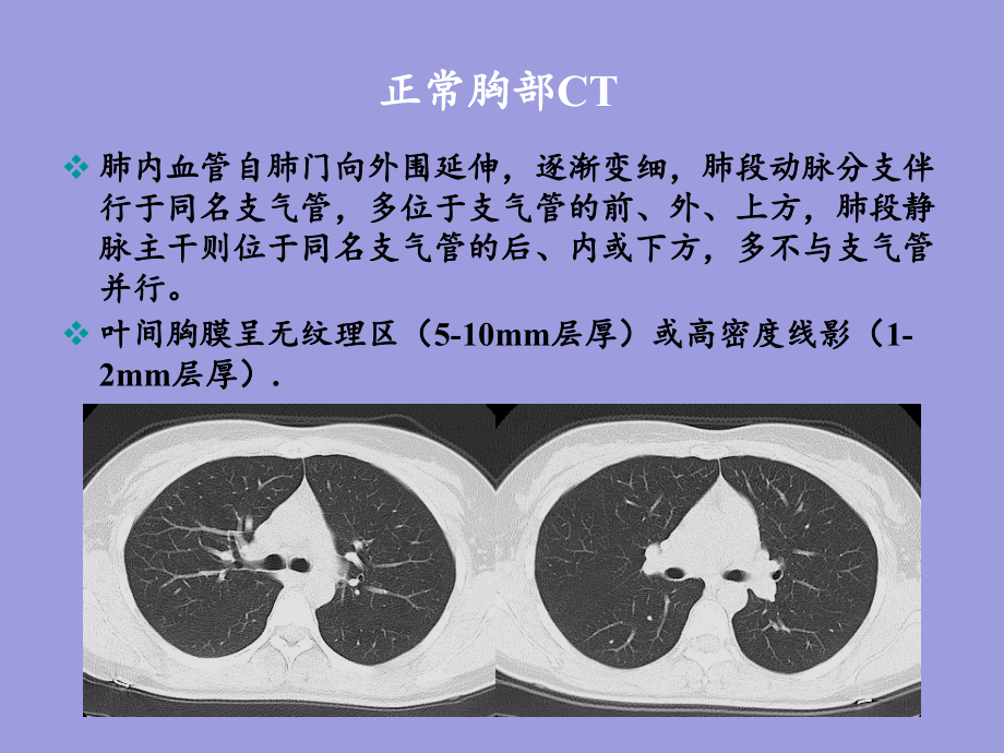 胸部CT下基本解剖与胸部一般病变_第4页