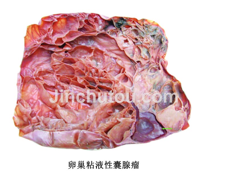 病理解剖学 肿瘤三-医学资料_第1页