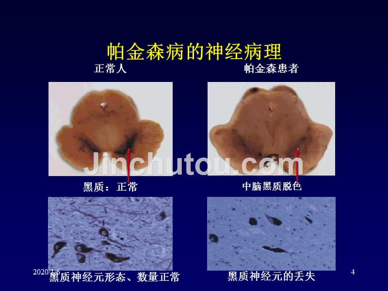 PD诊断治疗-医学资料_第4页