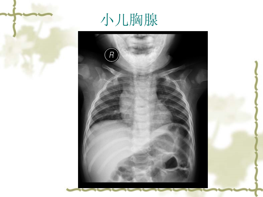 No.62014.3.7学习指导 七年制影像chest -呼吸常见病1支气管病变+肺炎+肺结核- 陈爱萍-医学资料_第2页