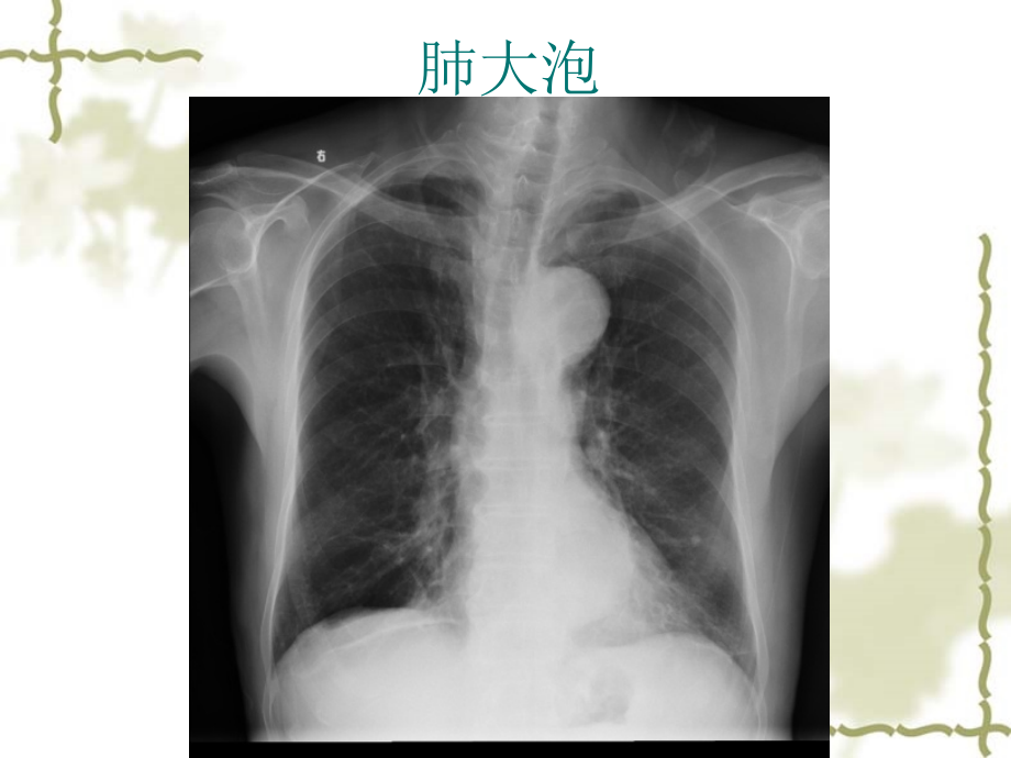 No.62014.3.7学习指导 七年制影像chest -呼吸常见病1支气管病变+肺炎+肺结核- 陈爱萍-医学资料_第3页