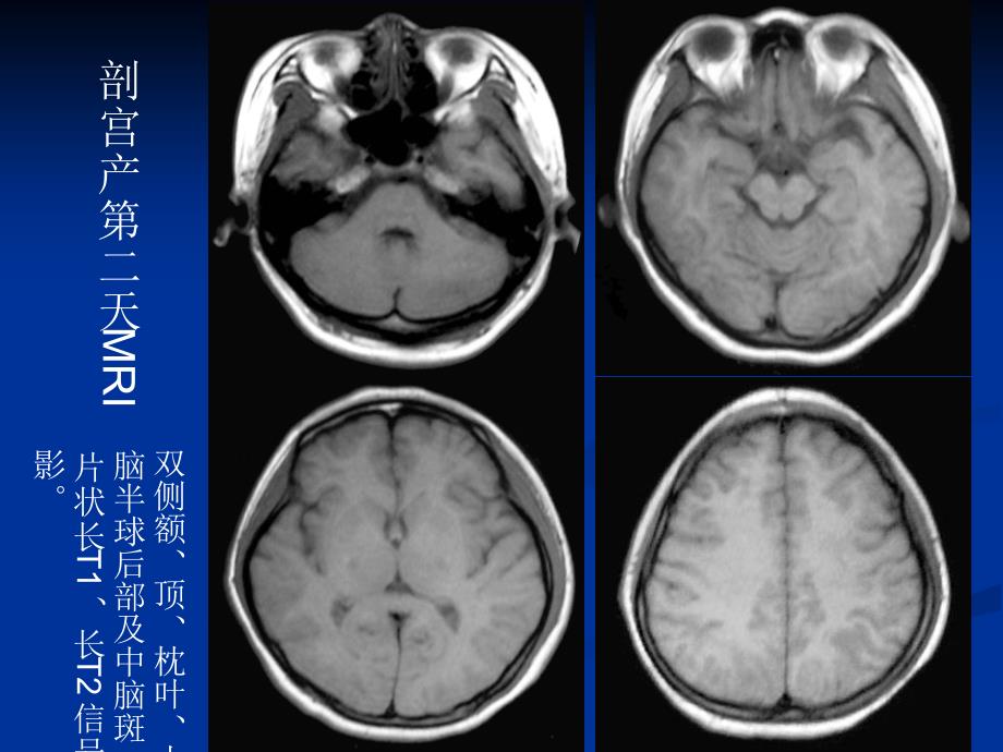 可逆性后部脑病综合症-医学资料_第4页