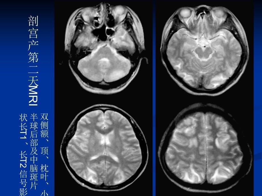 可逆性后部脑病综合症-医学资料_第5页