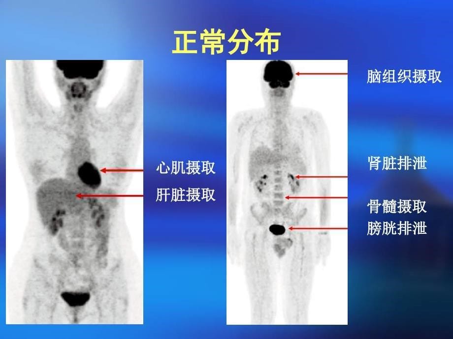 FDG-PET非肿瘤摄取-医学资料_第5页