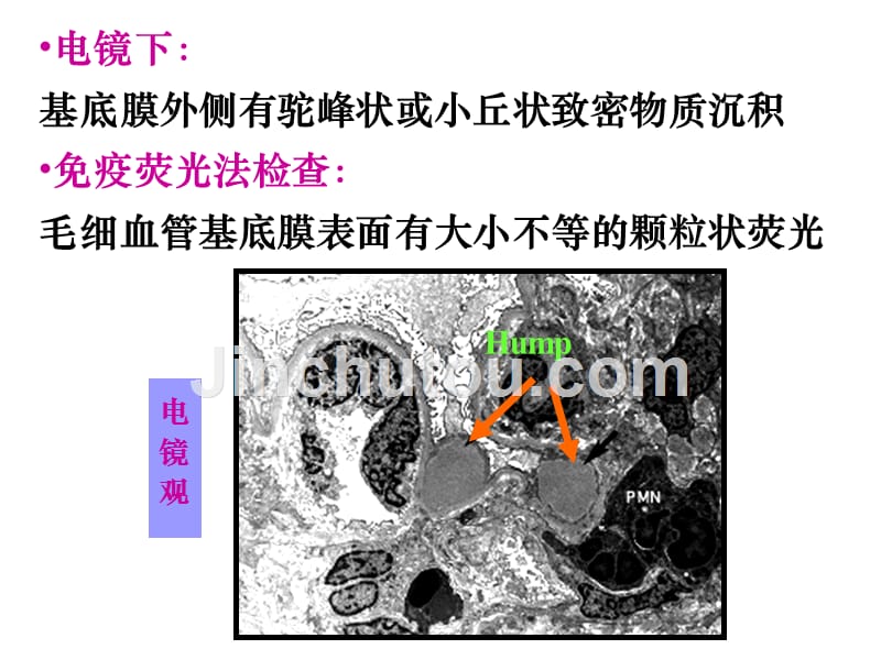 病理学-肾小球肾炎(下部分)-医学资料_第1页