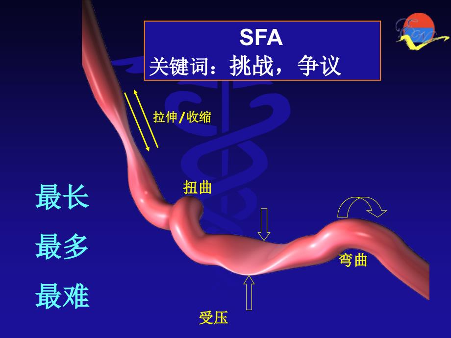 股浅动脉CTO的腔内治疗课件_第2页