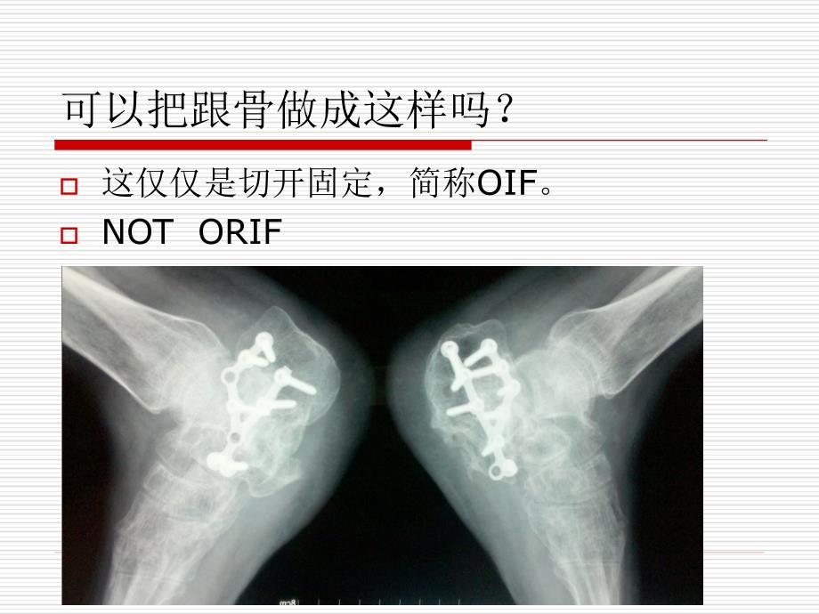 跟骨骨折ORIF的技巧PPT课件ppt课件_第4页